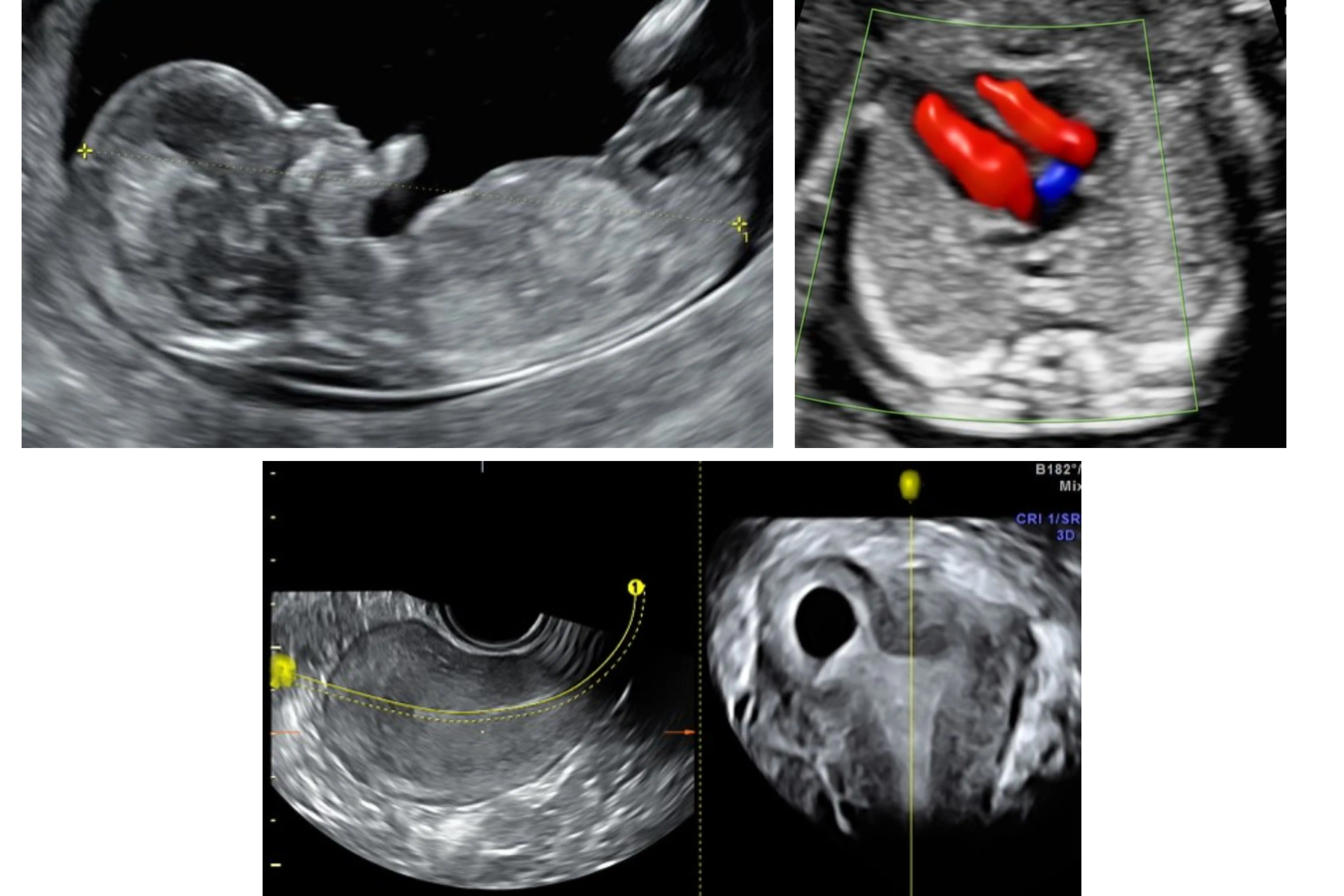 ISUOG GUIDELINE BASED OBGYN ULTRASOUND